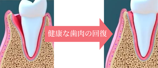 健康な歯肉の回復