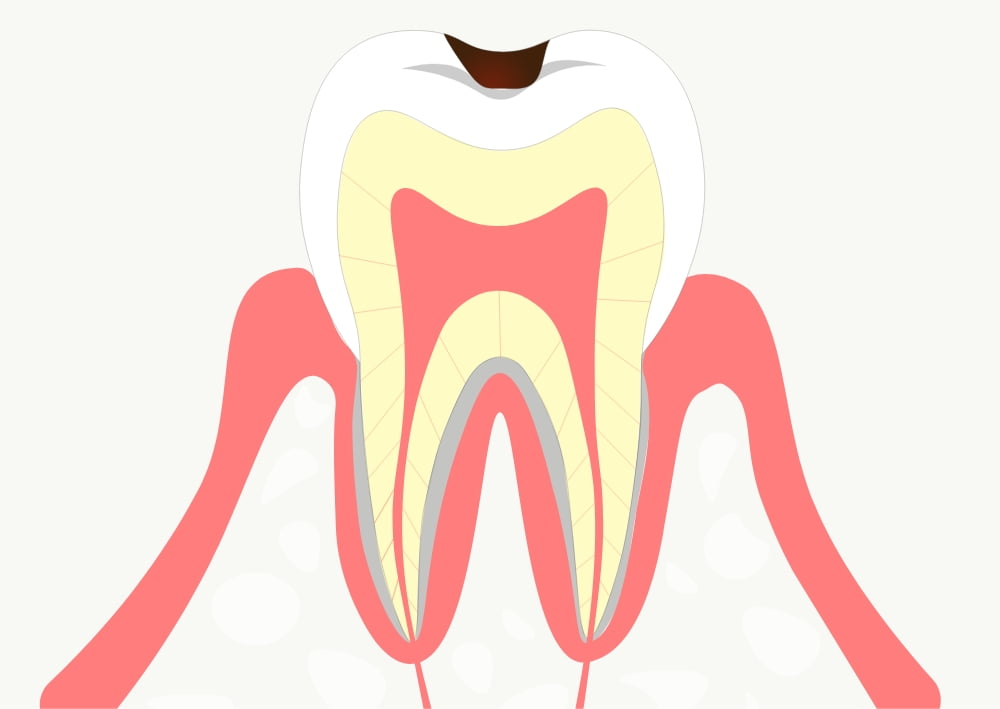 C1 ほとんど痛みのない虫歯
