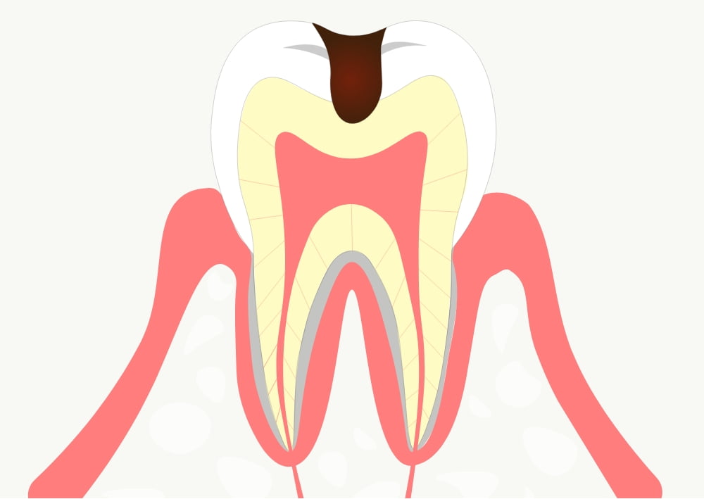 C2 黒ずみ・痛みがある虫歯