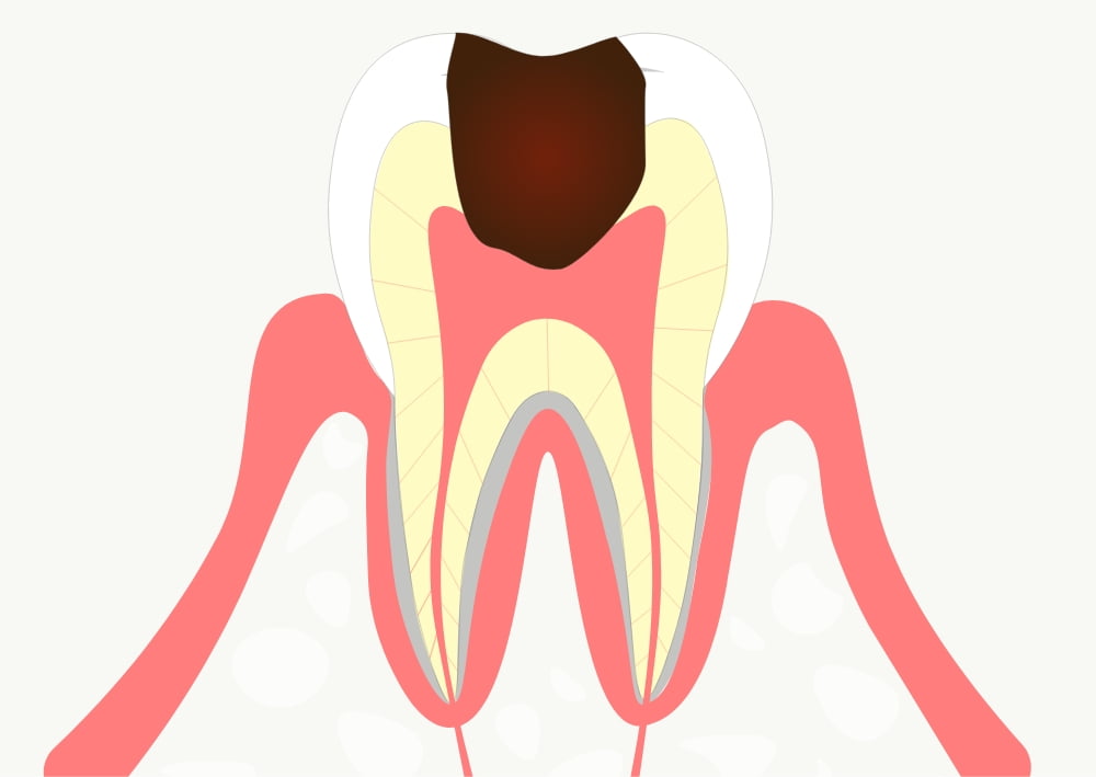 C3 ズキズキ痛む虫歯