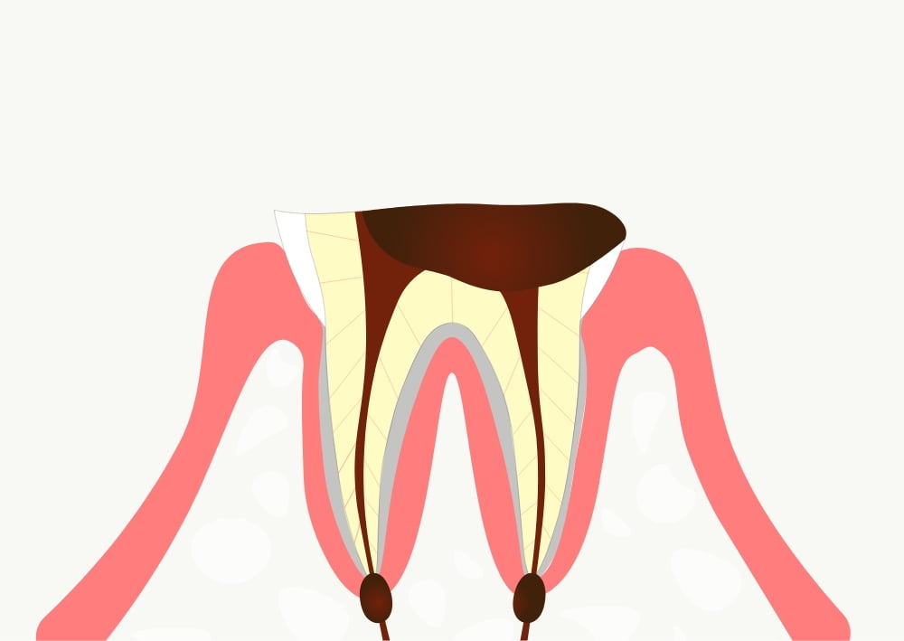 C4 ほとんど歯がない虫歯